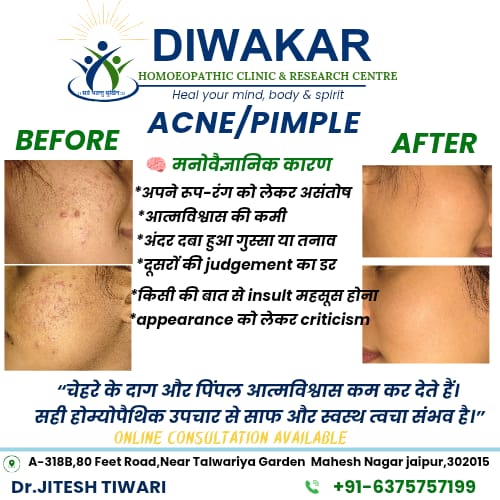 Before and after homoeopathic treatment for acne and pimples