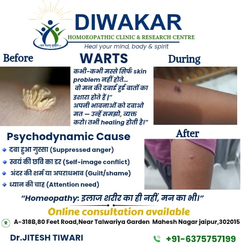 Warts on the arm before, during and after homoeopathic treatment