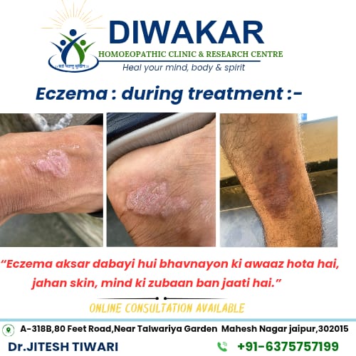 Chronic eczema during homoeopathic treatment