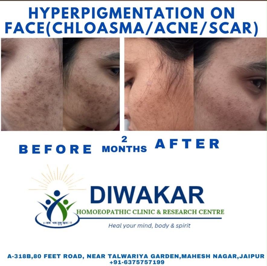 Before and after treatment for facial hyperpigmentation