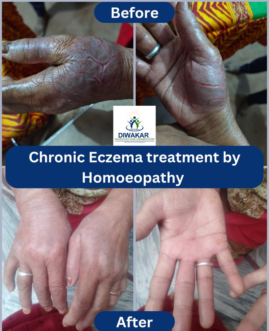 Before and after chronic eczema treatment by homoeopathy
