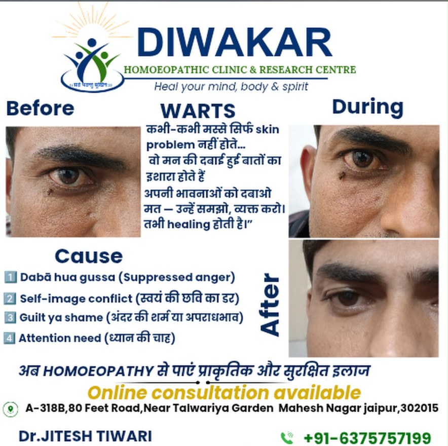 Patient case showing warts treated with homoeopathy