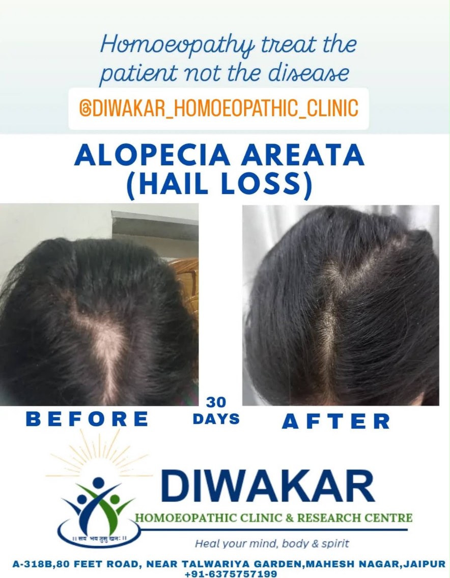 Before and after homoeopathic treatment for alopecia areata