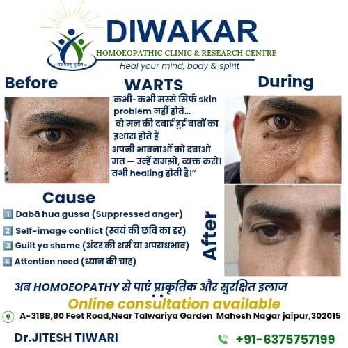 Warts near the eye before, during and after homoeopathic treatment