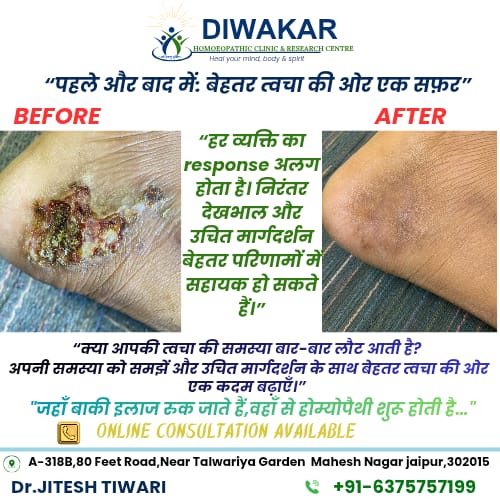 Before and after homoeopathic treatment of a chronic foot skin lesion