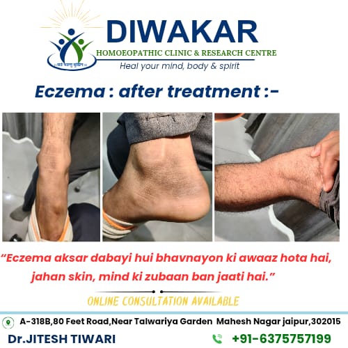 Chronic eczema after homoeopathic treatment
