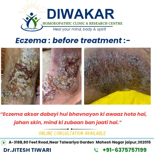 Chronic eczema before homoeopathic treatment