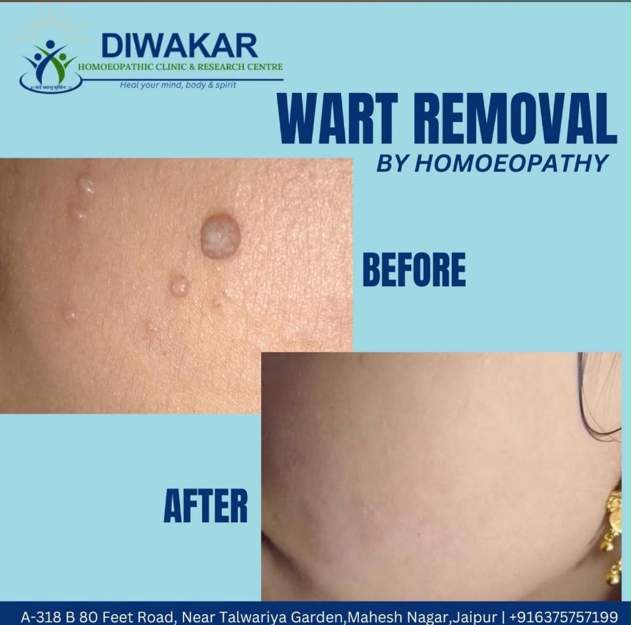 Before and after wart removal by homoeopathy