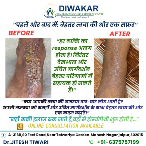 Before and after skin healing journey on the leg with homoeopathy